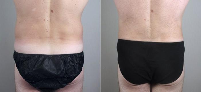 Liposuction Case 802 Before & After View #3 | Paramus, New Jersey | Parker Center for Plastic Surgery
