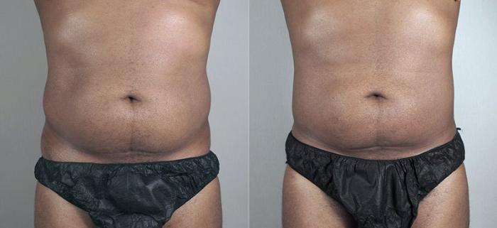 Liposuction Case 804 Before & After View #1 | Paramus, New Jersey | Parker Center for Plastic Surgery