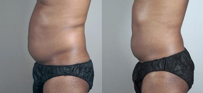 Liposuction Case 804 Before & After View #2 | Paramus, New Jersey | Parker Center for Plastic Surgery