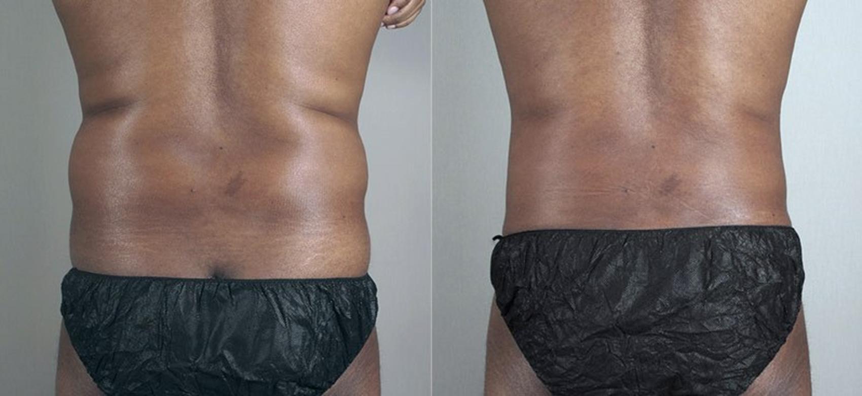 Liposuction Case 804 Before & After View #3 | Paramus, New Jersey | Parker Center for Plastic Surgery