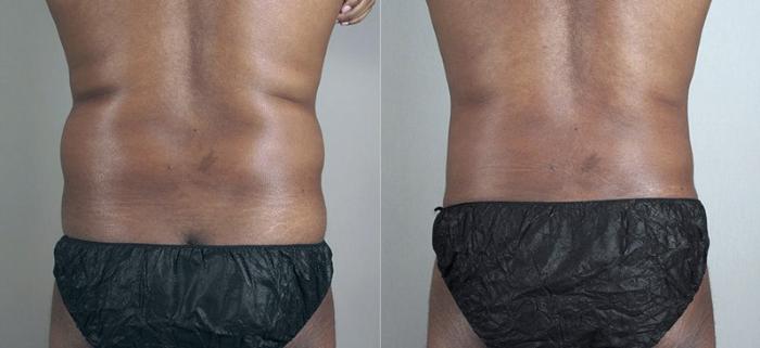 Liposuction Case 804 Before & After View #3 | Paramus, New Jersey | Parker Center for Plastic Surgery