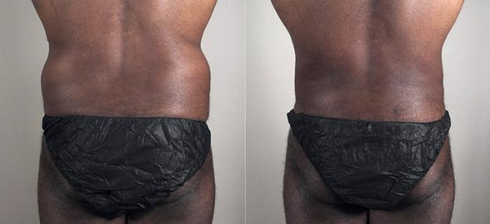 Liposuction Case 805 Before & After View #1 | Paramus, New Jersey | Parker Center for Plastic Surgery