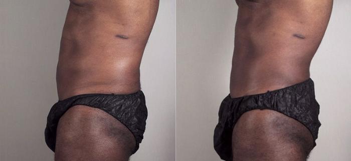 Liposuction Case 805 Before & After View #2 | Paramus, New Jersey | Parker Center for Plastic Surgery