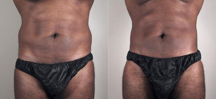 Liposuction Case 805 Before & After View #3 | Paramus, New Jersey | Parker Center for Plastic Surgery
