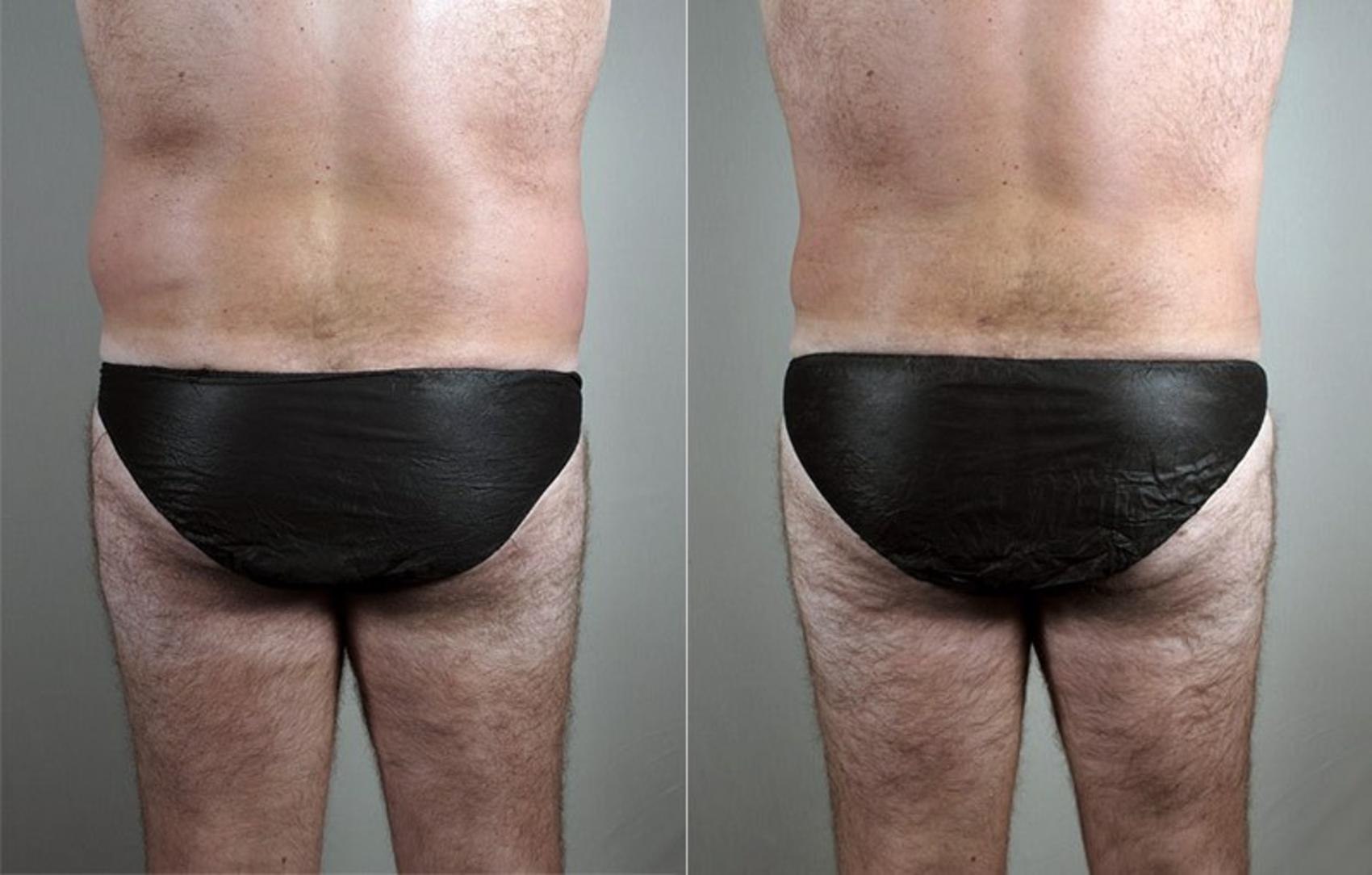 Liposuction Case 806 Before & After View #1 | Paramus, New Jersey | Parker Center for Plastic Surgery