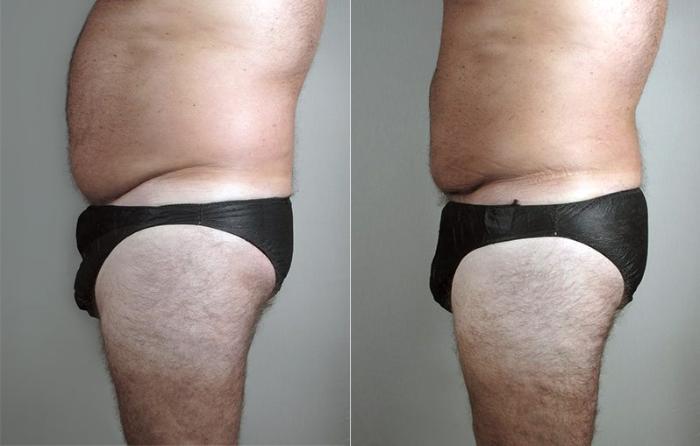 Liposuction Case 806 Before & After View #2 | Paramus, New Jersey | Parker Center for Plastic Surgery