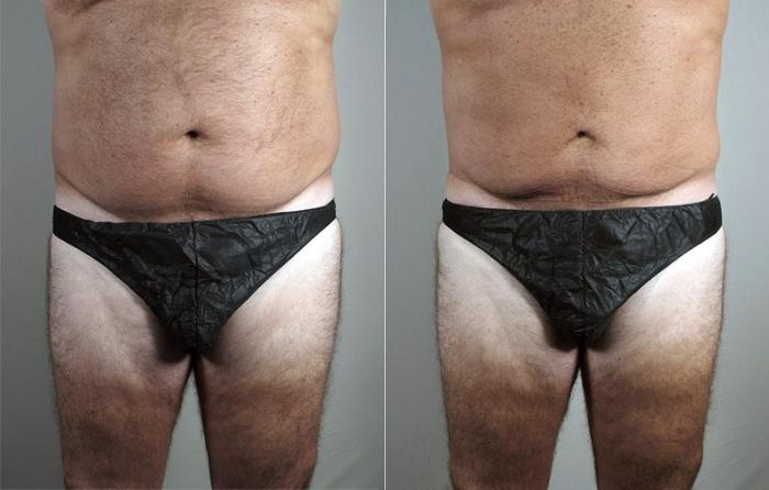Liposuction Case 806 Before & After View #3 | Paramus, New Jersey | Parker Center for Plastic Surgery
