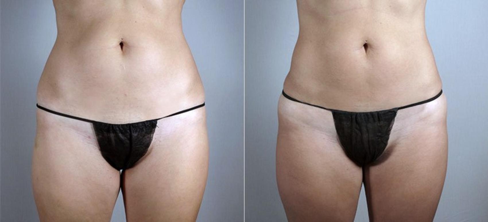 Liposuction Case 807 Before & After View #1 | Paramus, New Jersey | Parker Center for Plastic Surgery