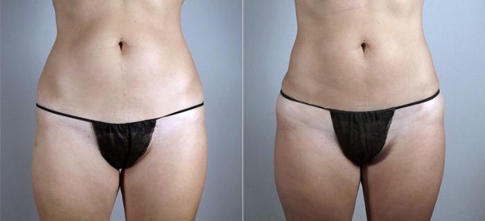 Liposuction Case 807 Before & After View #1 | Paramus, New Jersey | Parker Center for Plastic Surgery