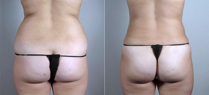 Liposuction Case 807 Before & After View #2 | Paramus, New Jersey | Parker Center for Plastic Surgery