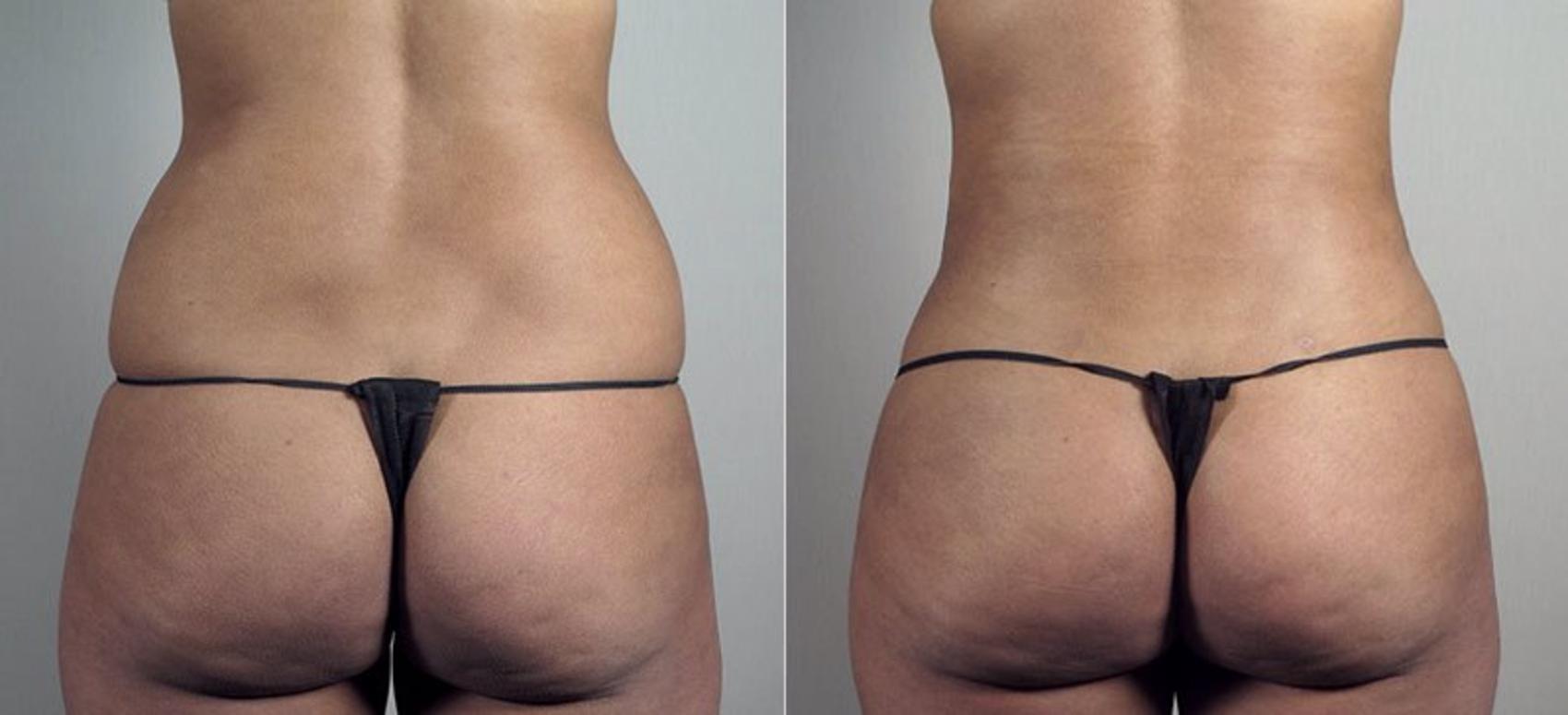 Liposuction Case 808 Before & After View #2 | Paramus, New Jersey | Parker Center for Plastic Surgery