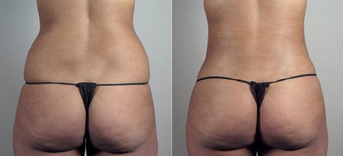 Liposuction Case 808 Before & After View #2 | Paramus, New Jersey | Parker Center for Plastic Surgery