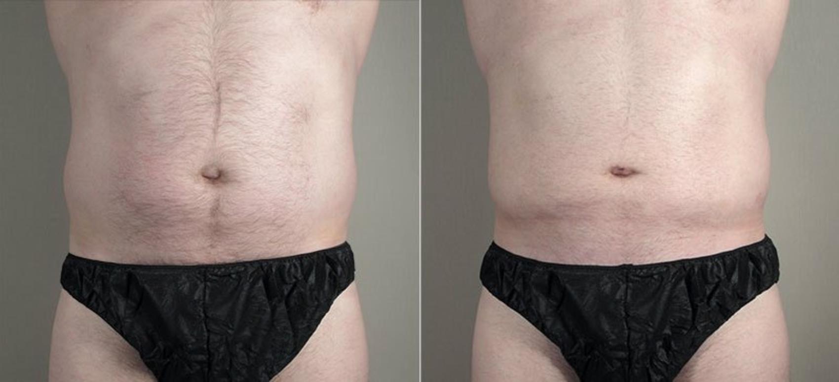 Liposuction Case 809 Before & After View #1 | Paramus, New Jersey | Parker Center for Plastic Surgery