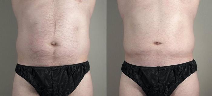 Liposuction Case 809 Before & After View #1 | Paramus, New Jersey | Parker Center for Plastic Surgery