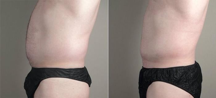 Liposuction Case 809 Before & After View #2 | Paramus, New Jersey | Parker Center for Plastic Surgery