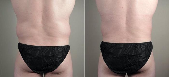 Liposuction Case 809 Before & After View #3 | Paramus, New Jersey | Parker Center for Plastic Surgery