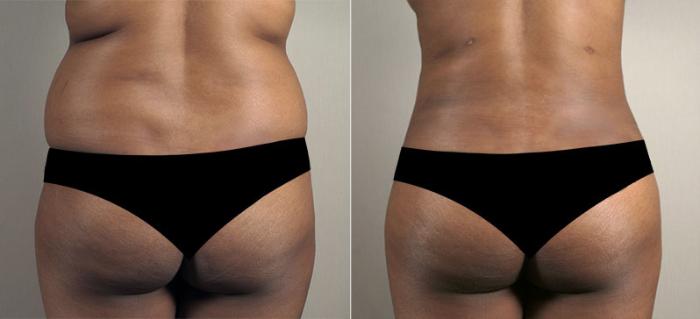 Liposuction Case 810 Before & After View #2 | Paramus, New Jersey | Parker Center for Plastic Surgery