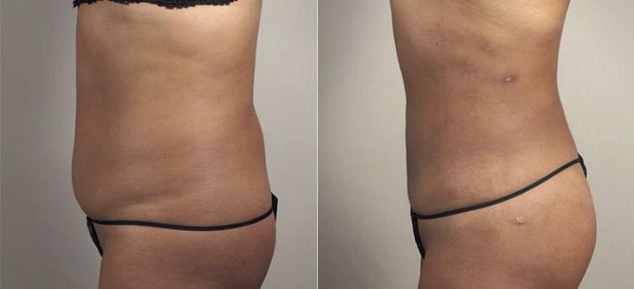 Liposuction Case 811 Before & After View #2 | Paramus, New Jersey | Parker Center for Plastic Surgery