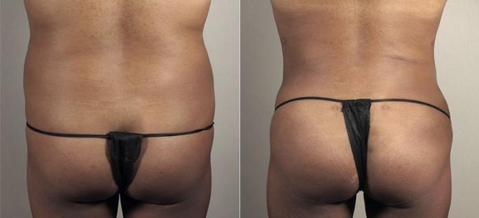 Liposuction Case 811 Before & After View #3 | Paramus, New Jersey | Parker Center for Plastic Surgery