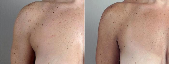 Liposuction Case 813 Before & After View #2 | Paramus, New Jersey | Parker Center for Plastic Surgery