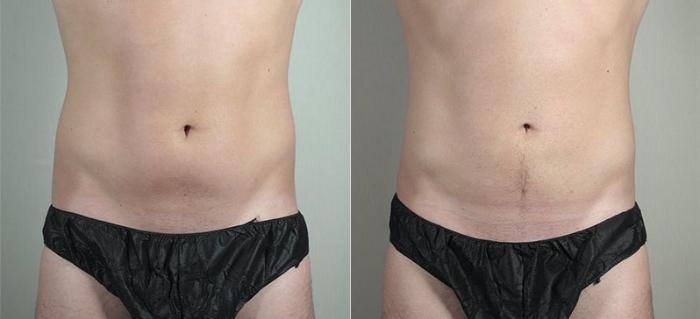 Liposuction Case 815 Before & After View #1 | Paramus, New Jersey | Parker Center for Plastic Surgery