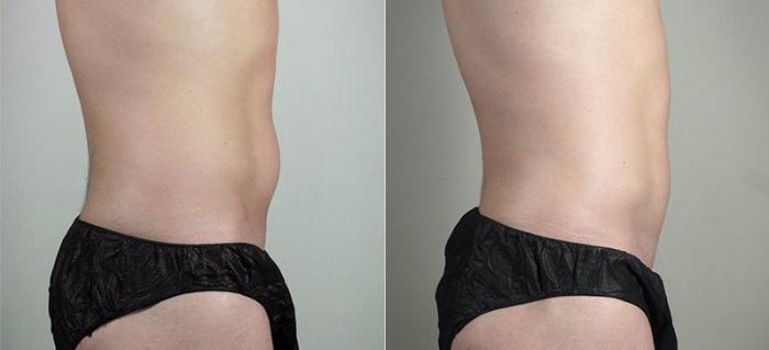 Liposuction Case 815 Before & After View #2 | Paramus, New Jersey | Parker Center for Plastic Surgery