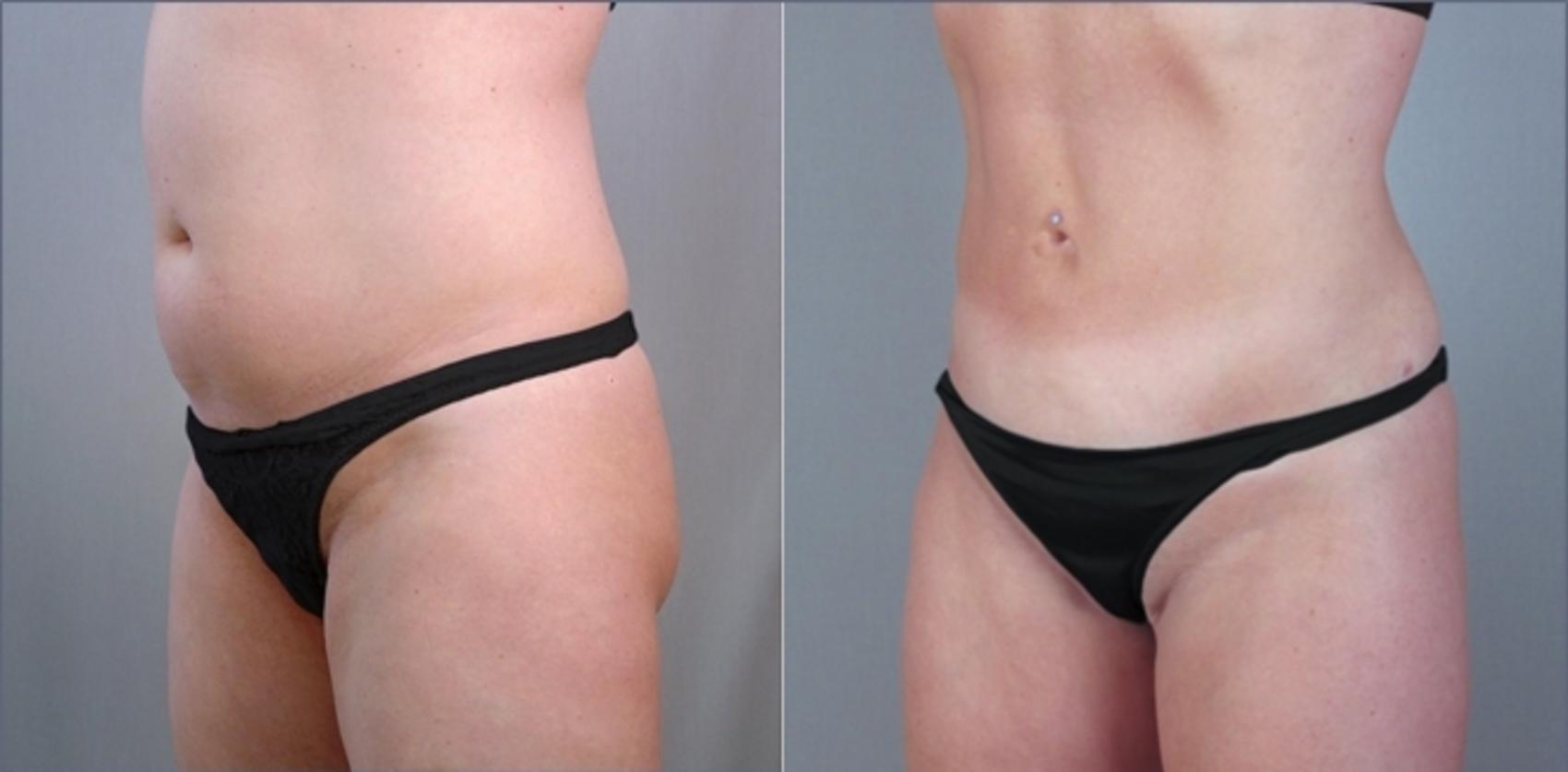 Liposuction Case 909 Before & After View #5 | Paramus, New Jersey | Parker Center for Plastic Surgery