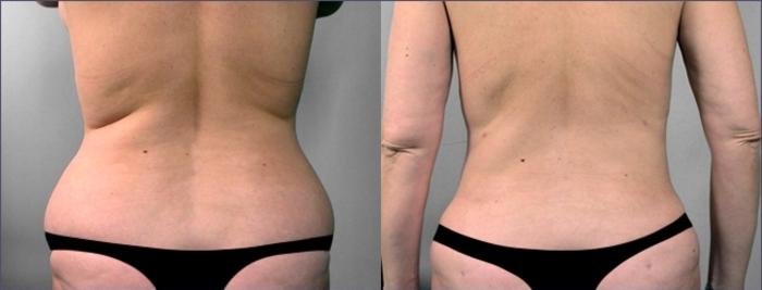 Liposuction Case 918 Before & After View #5 | Paramus, New Jersey | Parker Center for Plastic Surgery