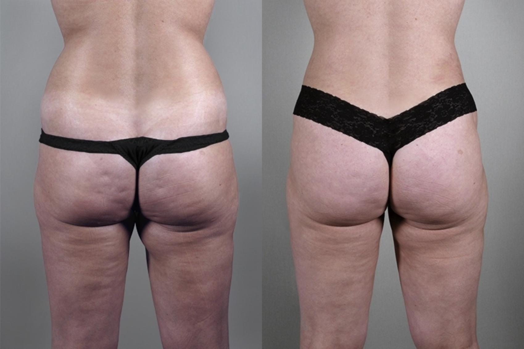 Liposuction Case 926 Before & After View #5 | Paramus, New Jersey | Parker Center for Plastic Surgery