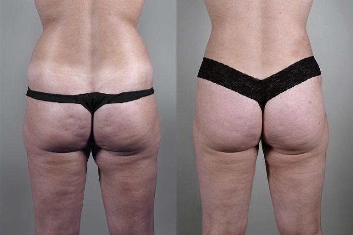 Liposuction Case 926 Before & After View #5 | Paramus, New Jersey | Parker Center for Plastic Surgery
