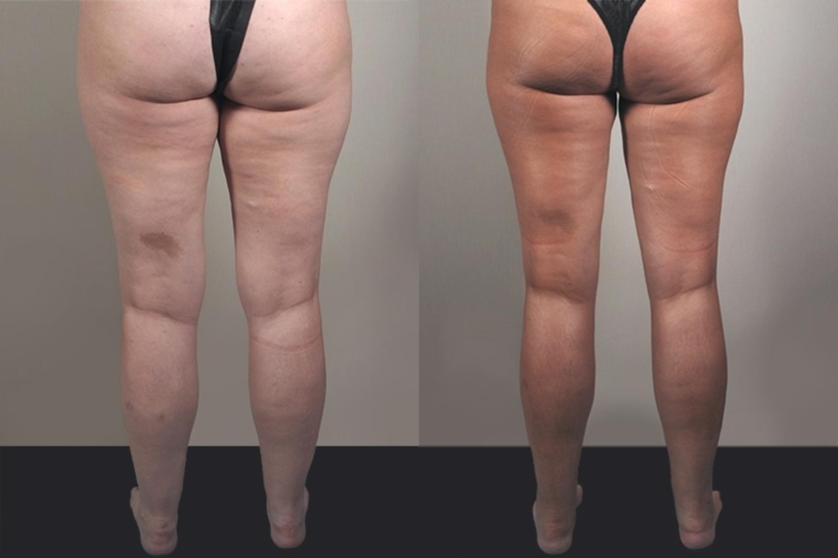 Liposuction Case 927 Before & After View #5 | Paramus, New Jersey | Parker Center for Plastic Surgery