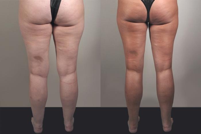 Liposuction Case 927 Before & After View #5 | Paramus, New Jersey | Parker Center for Plastic Surgery