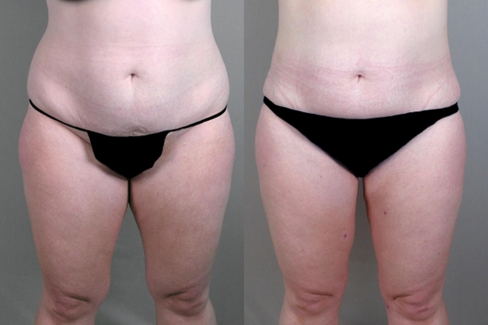 Liposuction Case 930 Before & After View #5 | Paramus, New Jersey | Parker Center for Plastic Surgery