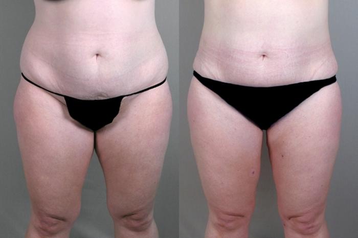 Liposuction Case 930 Before & After View #5 | Paramus, New Jersey | Parker Center for Plastic Surgery