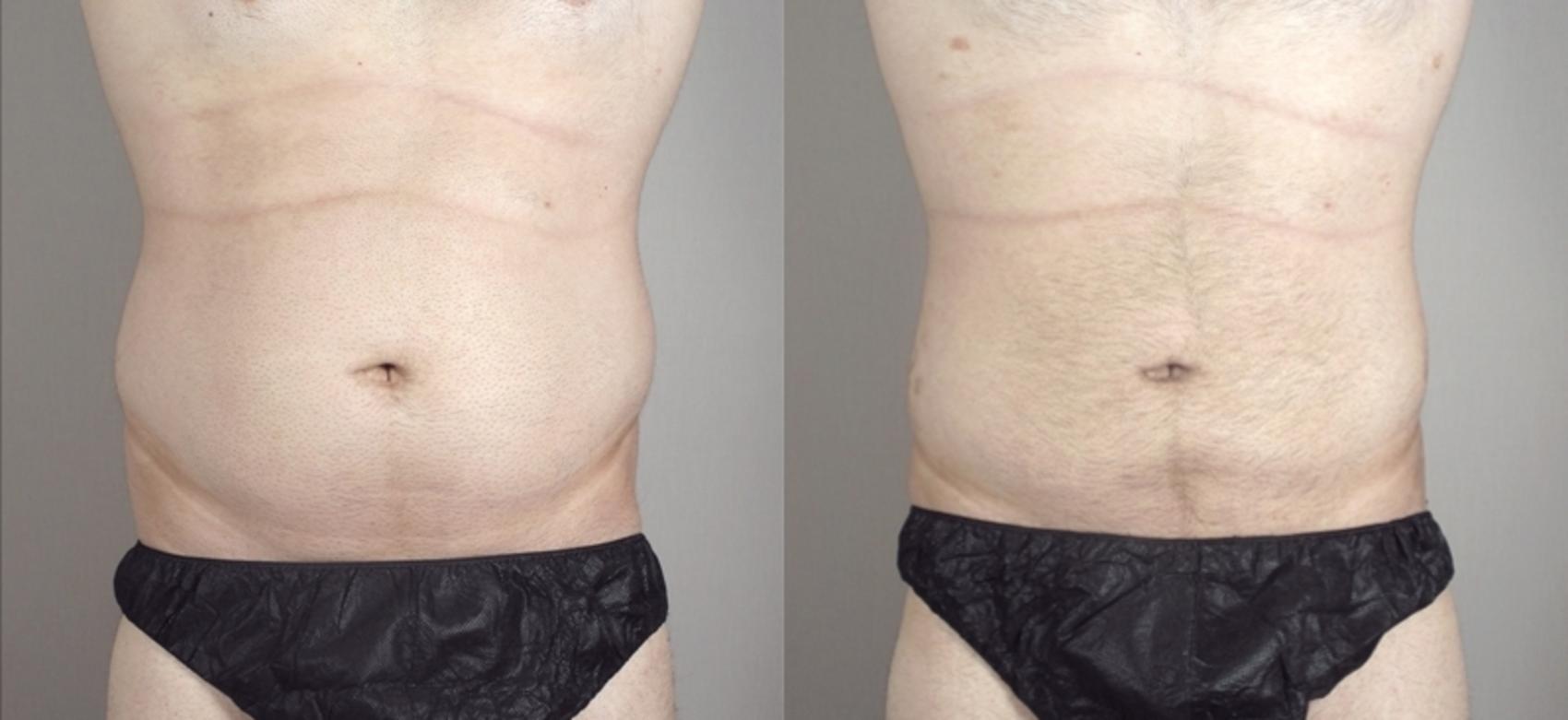 Liposuction Case 948 Before & After View #5 | Paramus, New Jersey | Parker Center for Plastic Surgery