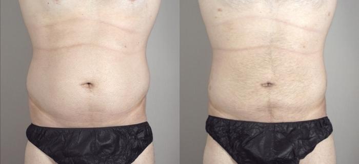 Liposuction Case 948 Before & After View #5 | Paramus, New Jersey | Parker Center for Plastic Surgery
