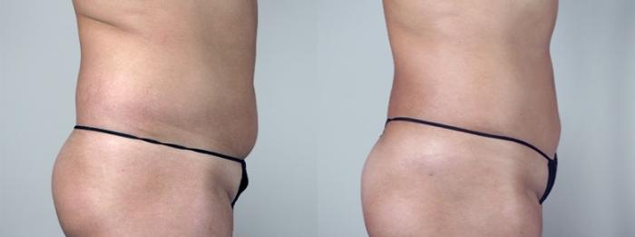 Liposuction Case 962 Before & After View #5 | Paramus, New Jersey | Parker Center for Plastic Surgery