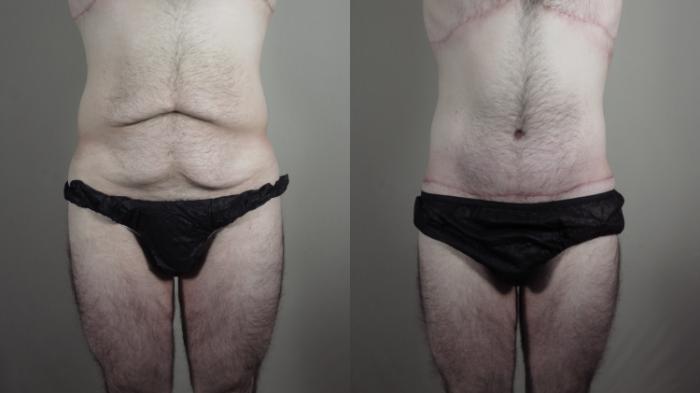 Male Breast Reduction Case 1010 Before & After Front Body  | Paramus, New Jersey | Parker Center for Plastic Surgery