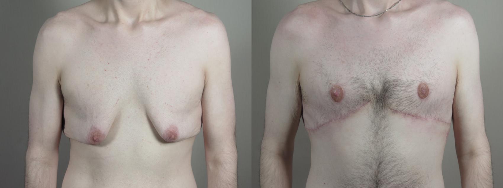 Male Breast Reduction Case 1010 Before & After Front | Paramus, New Jersey | Parker Center for Plastic Surgery