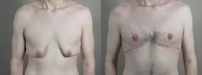 Male Breast Reduction Case 1010 Before & After Front | Paramus, New Jersey | Parker Center for Plastic Surgery
