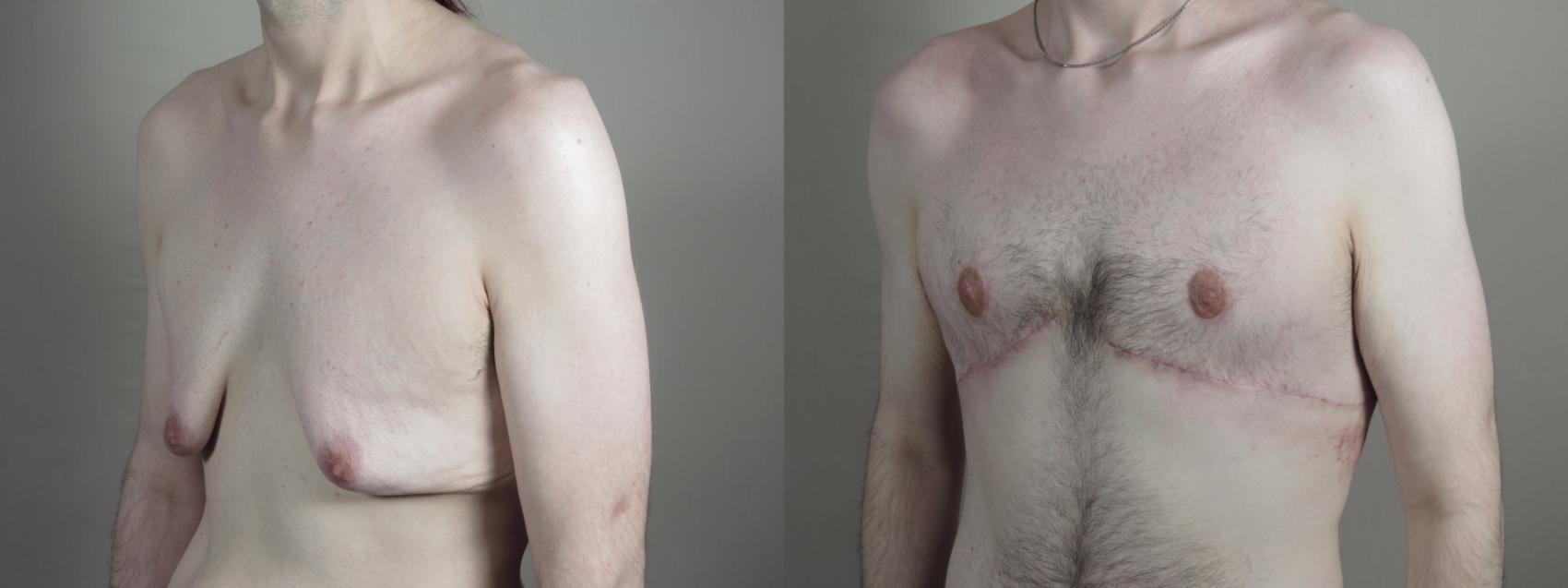 Male Breast Reduction Case 1010 Before & After Right Oblique | Paramus, New Jersey | Parker Center for Plastic Surgery