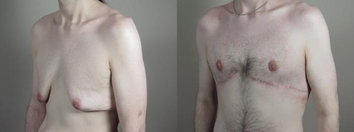 Male Breast Reduction Case 1010 Before & After Right Oblique | Paramus, New Jersey | Parker Center for Plastic Surgery
