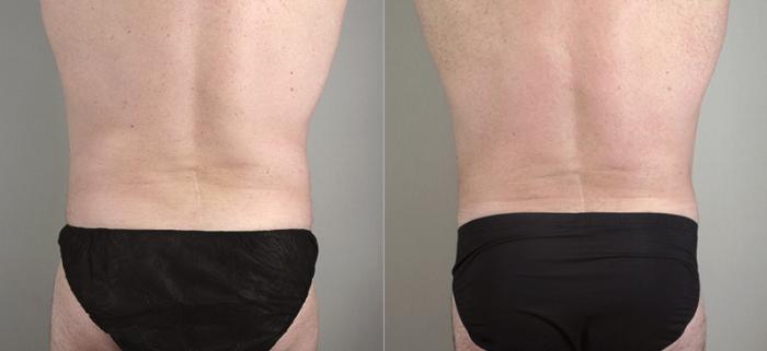 Male Breast Reduction Case 1295 Before & After Back | Paramus, New Jersey | Parker Center for Plastic Surgery