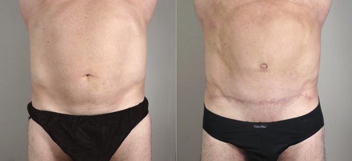 Male Breast Reduction Case 1295 Before & After front  | Paramus, New Jersey | Parker Center for Plastic Surgery