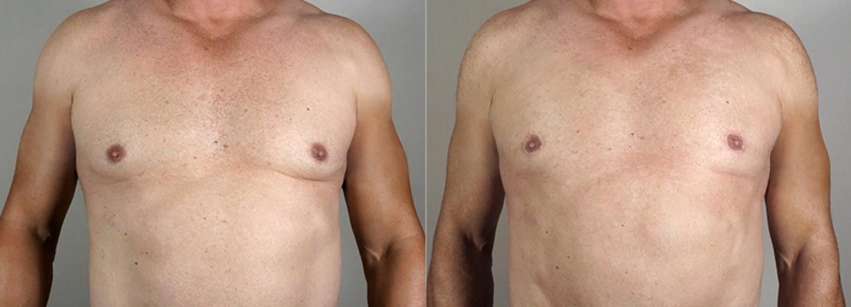 Male Breast Reduction Case 1295 Before & After Front | Paramus, New Jersey | Parker Center for Plastic Surgery