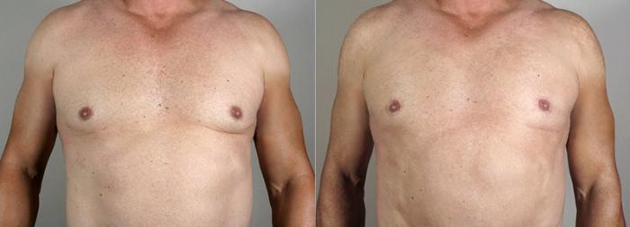 Male Breast Reduction Case 1295 Before & After Front | Paramus, New Jersey | Parker Center for Plastic Surgery
