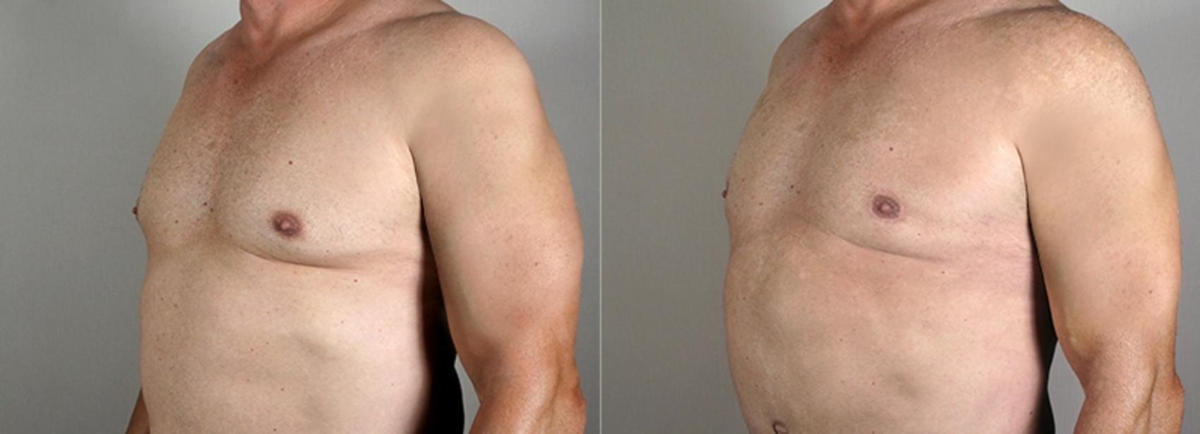 Male Breast Reduction Case 1295 Before & After Left Oblique | Paramus, New Jersey | Parker Center for Plastic Surgery