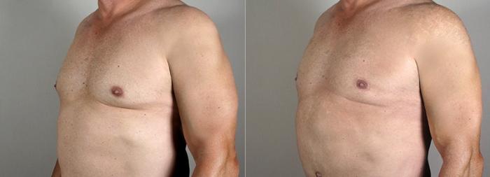 Male Breast Reduction Case 1295 Before & After Left Oblique | Paramus, New Jersey | Parker Center for Plastic Surgery