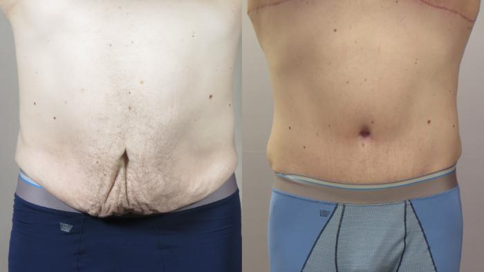Male Breast Reduction Case 1570 Before & After 1 | Paramus, New Jersey | Parker Center for Plastic Surgery