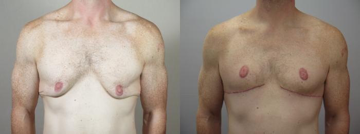 Male Breast Reduction Case 1570 Before & After Front | Paramus, New Jersey | Parker Center for Plastic Surgery